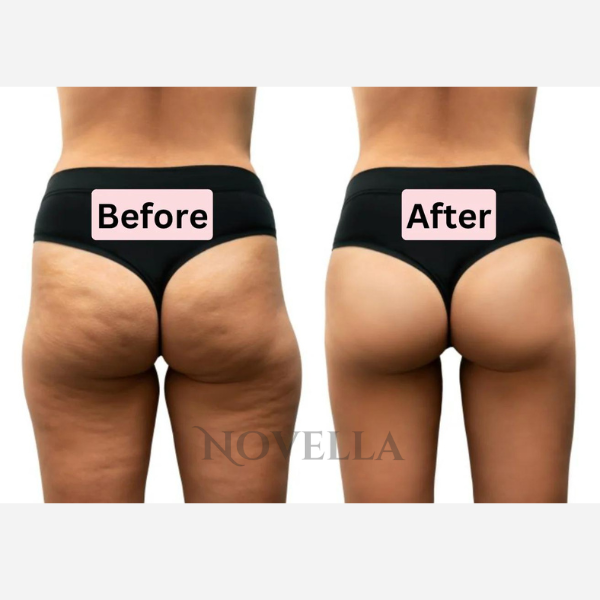Novella™ Anti-Cellulite Massager V2